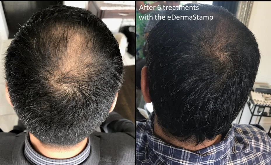Before and after — Dermaroller TWIST microneedling
