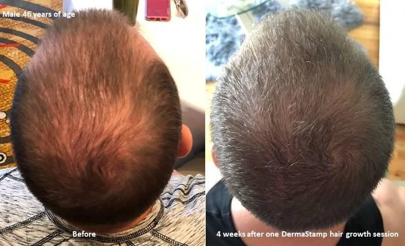 Before and after — Dermaroller TWIST microneedling