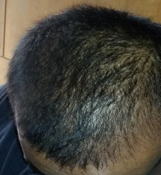 Before and after — Dermaroller TWIST microneedling