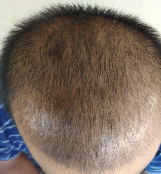 Before and after — Dermaroller TWIST microneedling