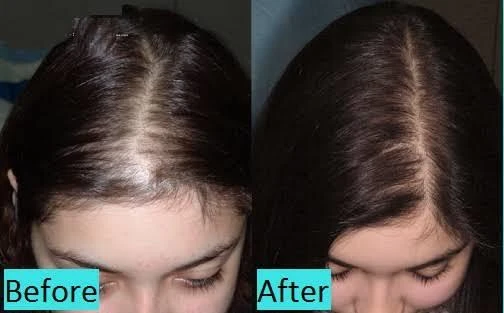 Hair Loss results