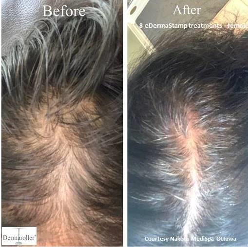 Before and after — Dermaroller TWIST microneedling