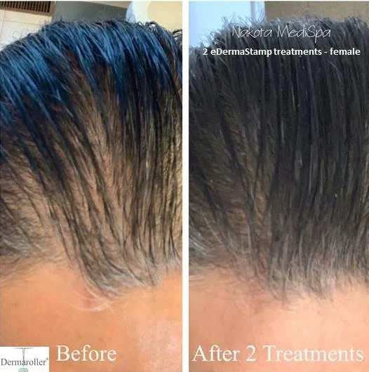 Before and after — Dermaroller TWIST microneedling