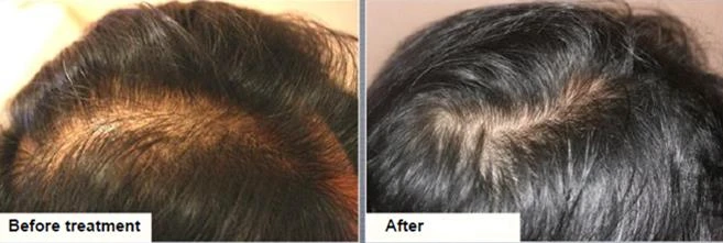 Before and after — Dermaroller TWIST microneedling