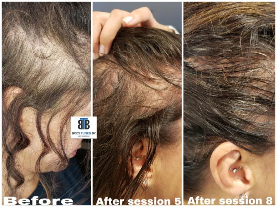 Before and after — Dermaroller TWIST microneedling