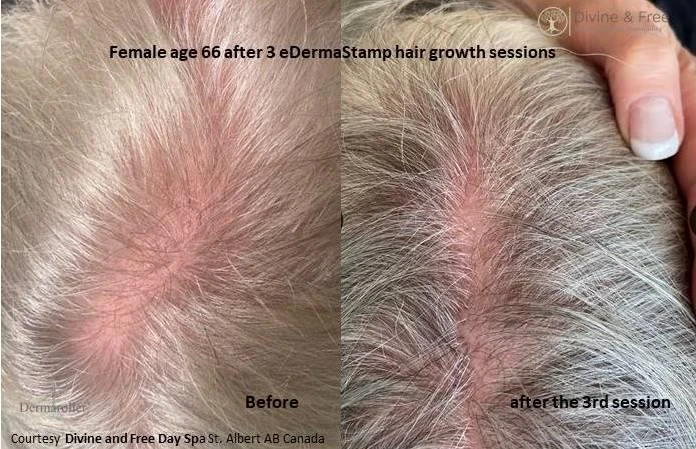 Before and after — Dermaroller TWIST microneedling