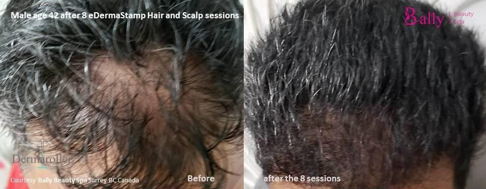 Before and after — Dermaroller TWIST microneedling