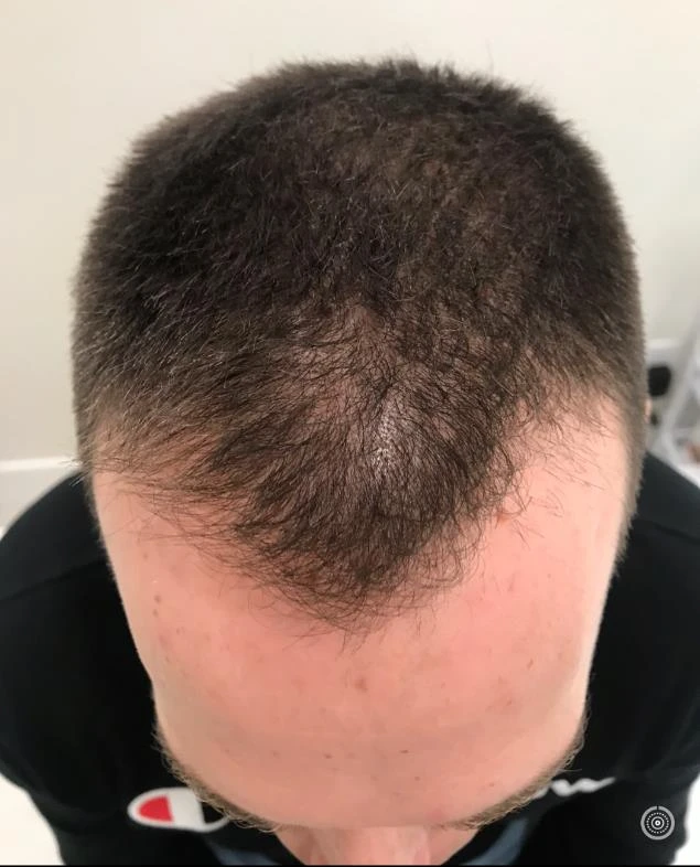 Before and after — Dermaroller TWIST microneedling
