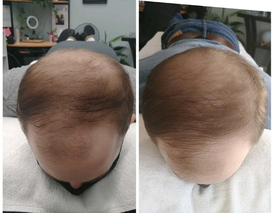 Before and after — Dermaroller TWIST microneedling