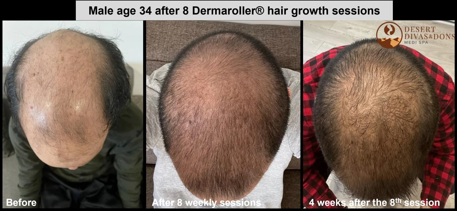 Before and after — Dermaroller TWIST microneedling