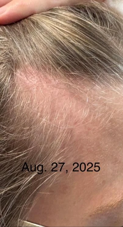 Before and after — Dermaroller TWIST microneedling