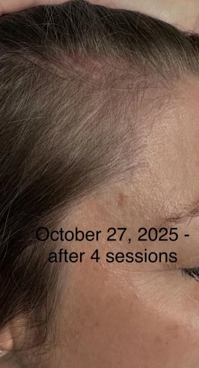 Before and after — Dermaroller TWIST microneedling