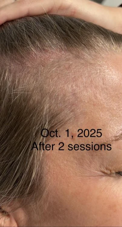 Before and after — Dermaroller TWIST microneedling