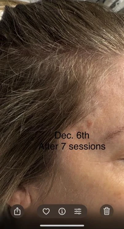Before and after — Dermaroller TWIST microneedling