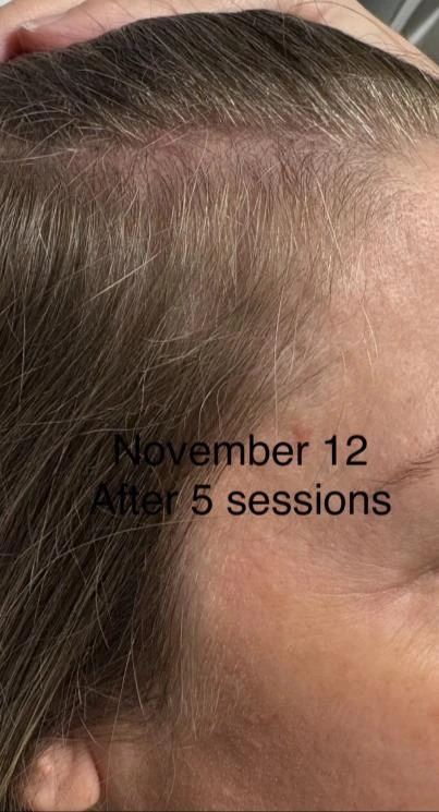 Before and after — Dermaroller TWIST microneedling