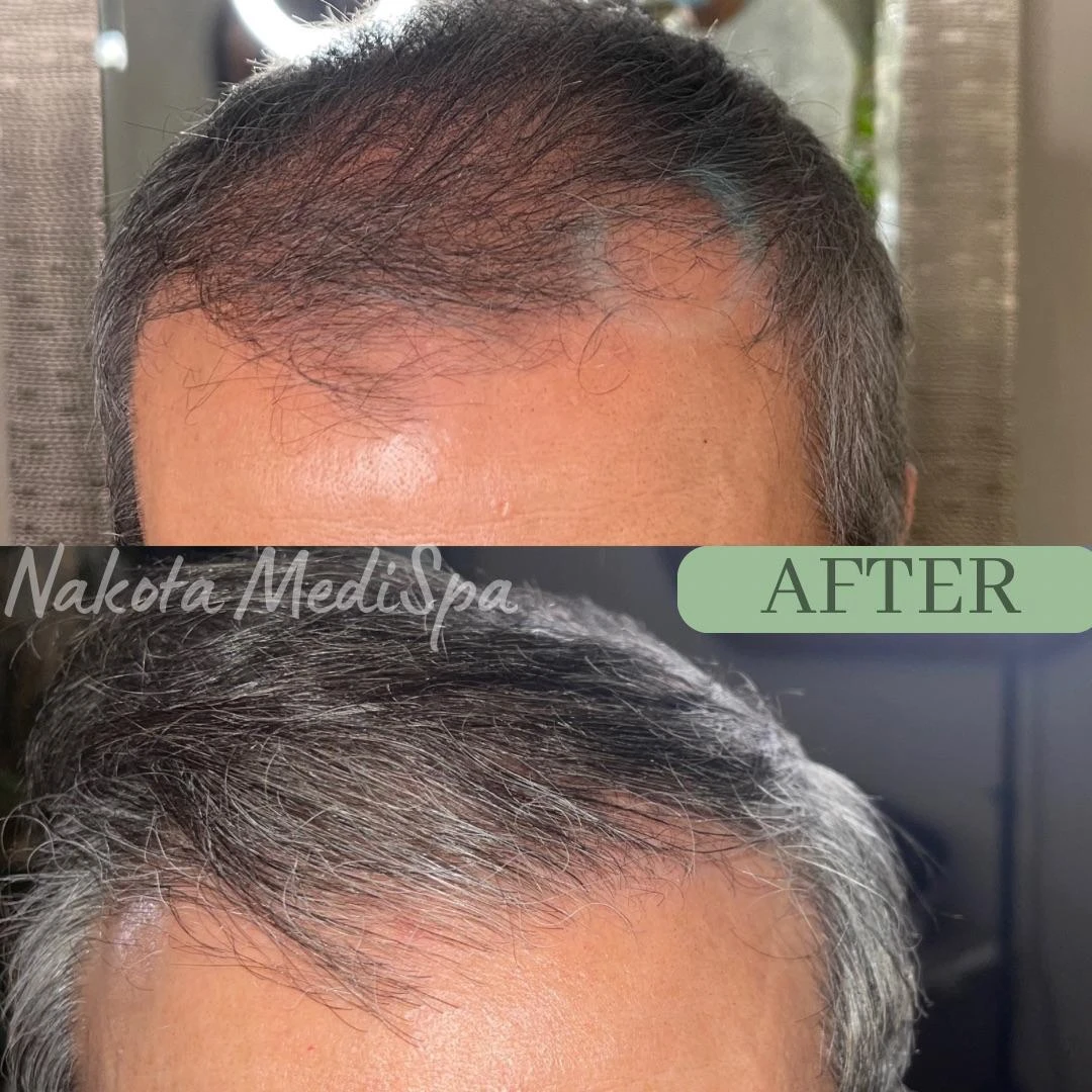 Before and after — Dermaroller TWIST microneedling