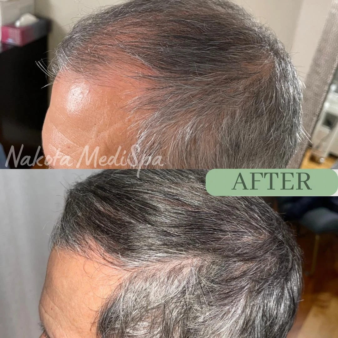 Before and after — Dermaroller TWIST microneedling