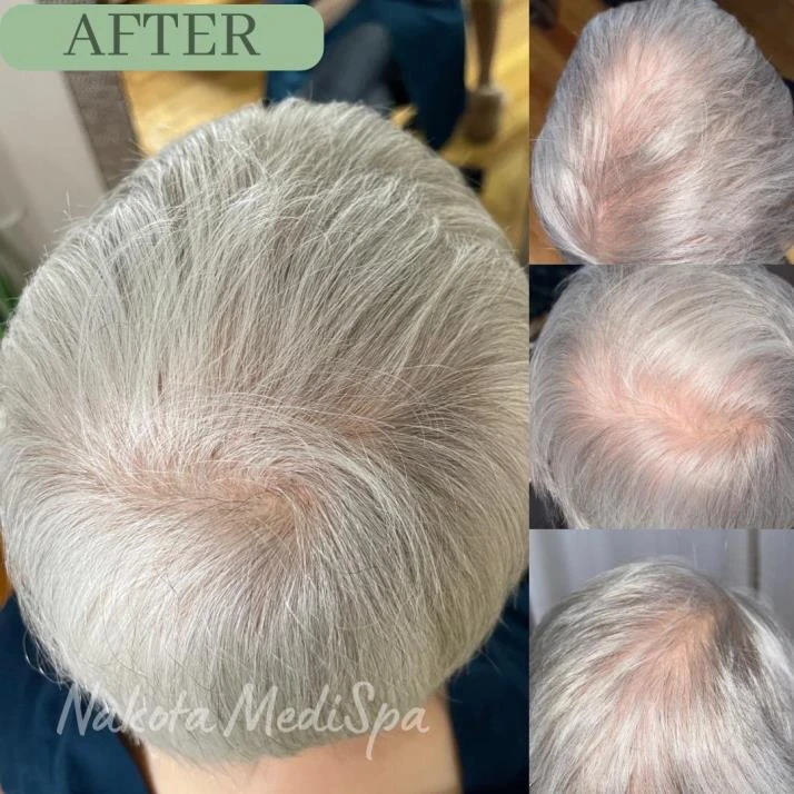 Before and after — Dermaroller TWIST microneedling