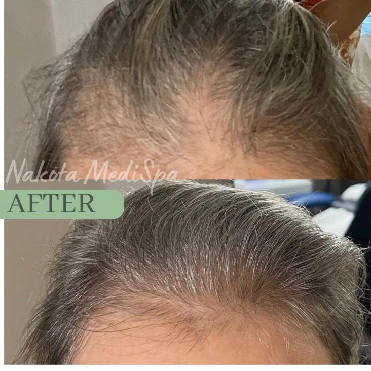 Before and after — Dermaroller TWIST microneedling
