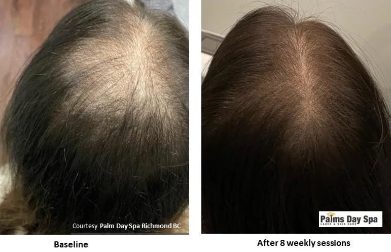 Before and after — Dermaroller TWIST microneedling