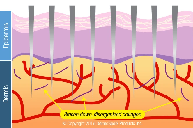 Microneedling treatment diagram